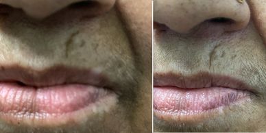Repigmentation in Lip Vitiligo • Vitiligo Treatment • Dr Kuldeep Bhardwaj, Dermatologist in Jabalpur