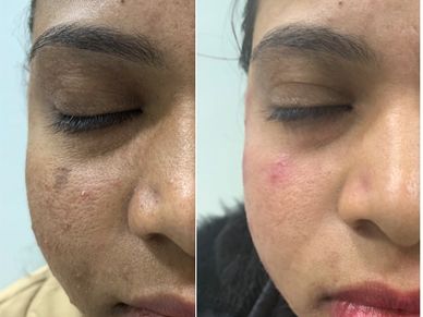 Dr Kuldeep Bhardwaj • Laser Skin Lightening