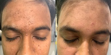 Comedonal Acne Treatments • Dr Kuldeep Bhardwaj, Dermatologist in Jabalpur