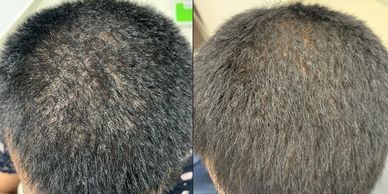 Plasma Hair Therapy for Hair Loss • Hair Treatments • Dermatologist in Jabalpur by Dr Kuldeep Bhardw