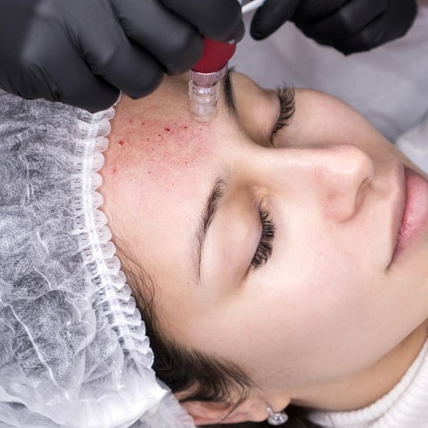 Microneedling treatment