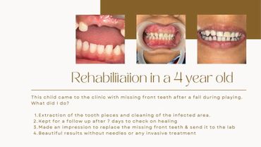 Dental rehabilitation for a 4-year-old with missing front teeth after a fall.