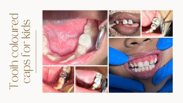 Various tooth-colored dental caps on kids' teeth shown in close-up images.