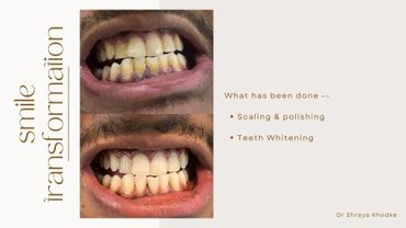 Before and after images showing teeth whitening and polishing results.