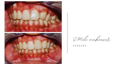 Before and after smile makeover with dental veneers showing improved teeth appearance.