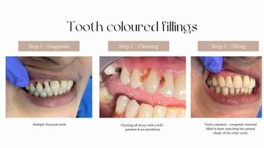 Three-step process of tooth-colored fillings from diagnosis to filling.