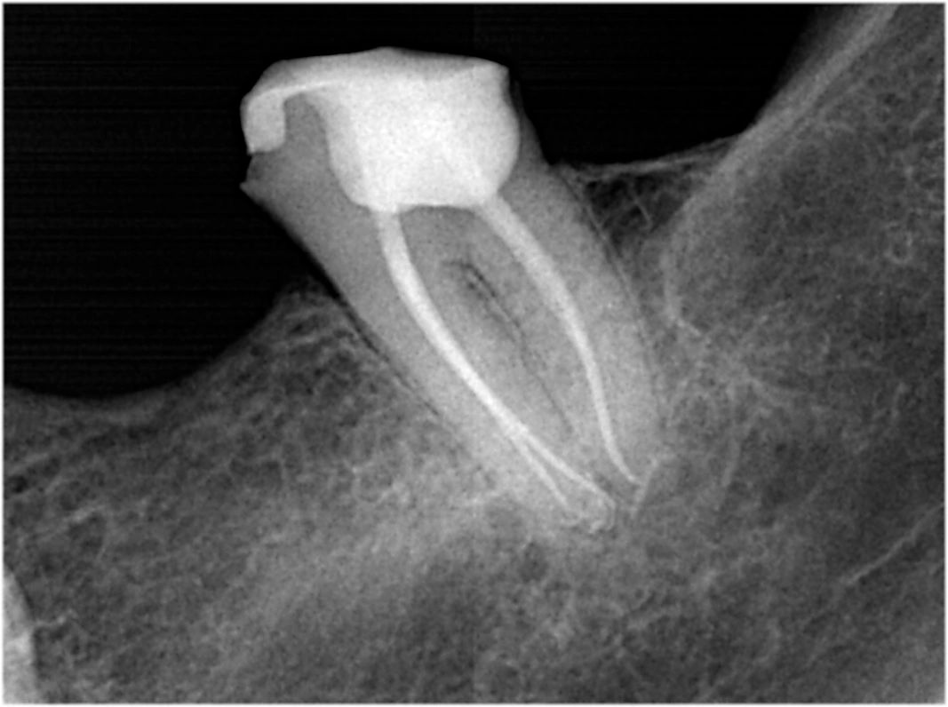 Root Canal Treatment and Root Canal Surgery Garrett M. Guess DDS