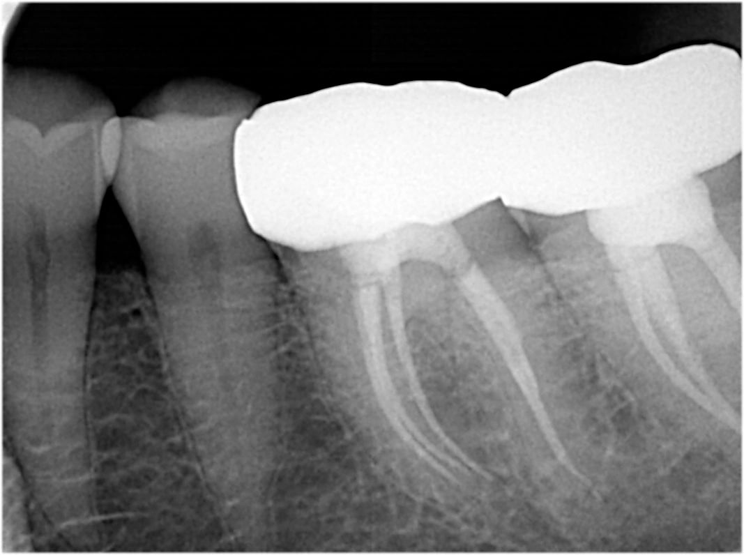 Root Canal Treatment and Root Canal Surgery Garrett M. Guess DDS