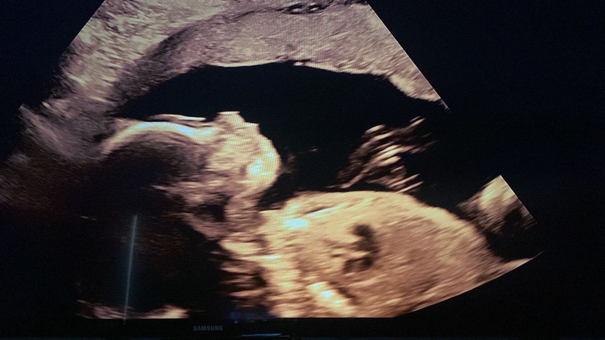 a photo of the head doula's ultrasound