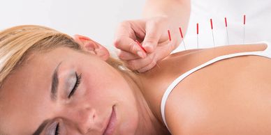 Acupuncture being performed on a blonde lady's back.