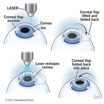 LASIK, PRK, ICL and RLE | North York Eye Clinic