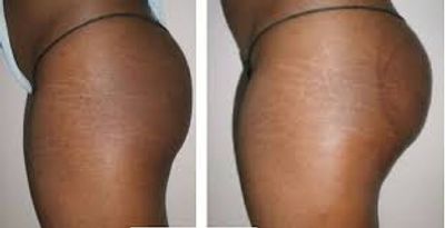 Sculpting Sensuality: The Brazilian Buttock Lift Unveiled