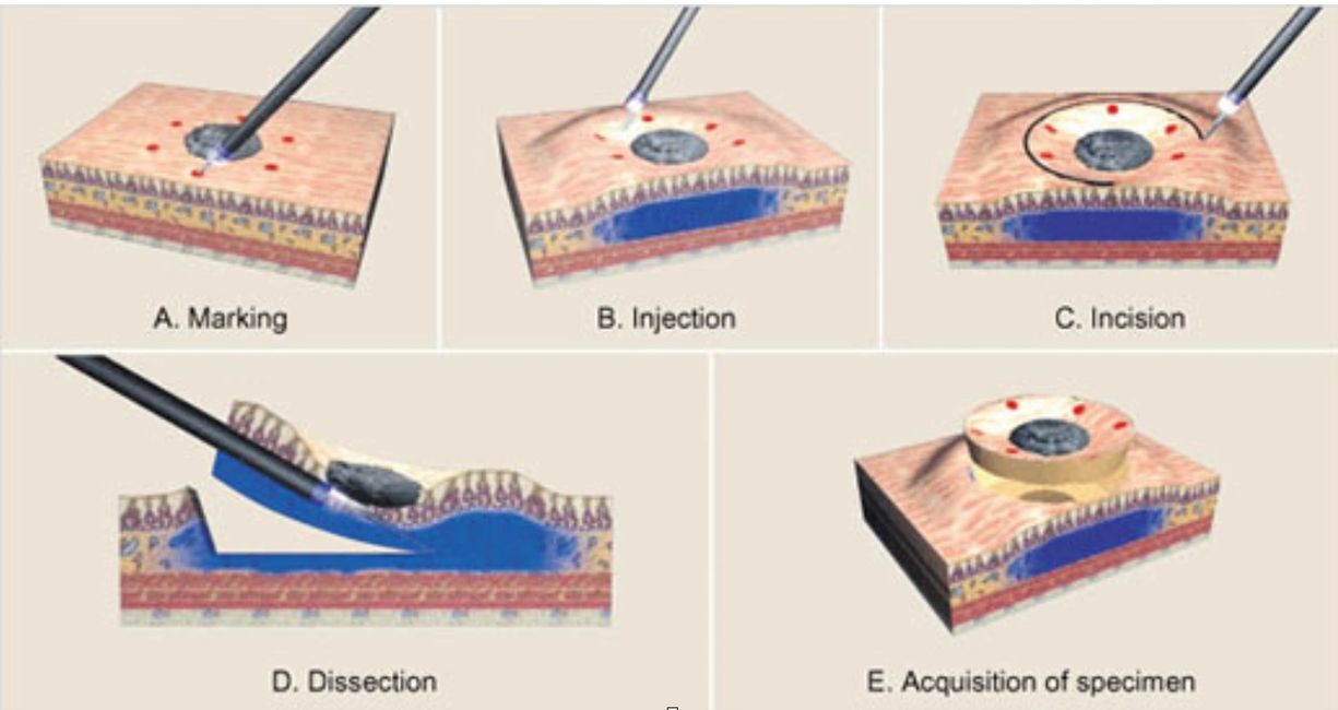 ESD Louisville's Top Gastro Doctor
