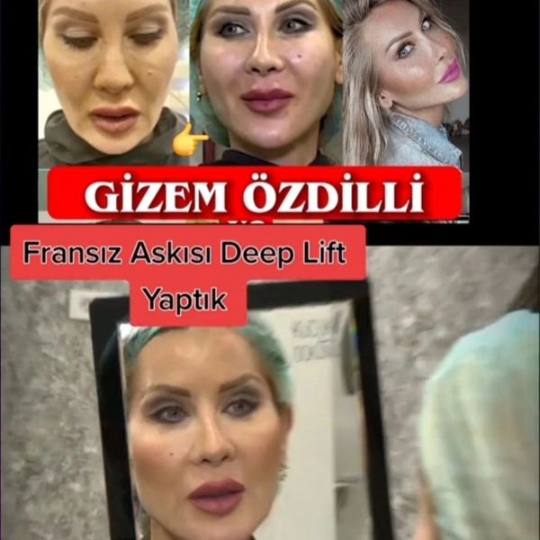 Fransız Askısı Estetiği yaptıran gizem özdilli öncesi sonrası