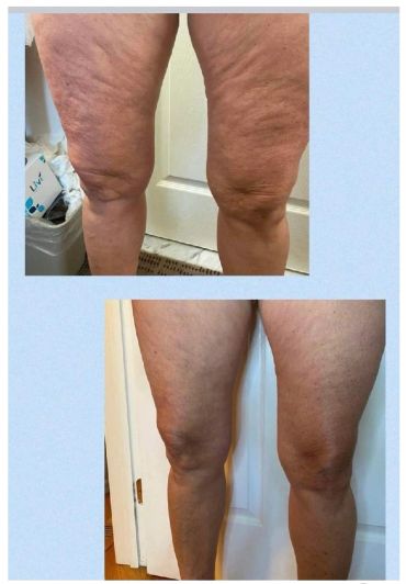 Before and after images of legs showing reduced cellulite.