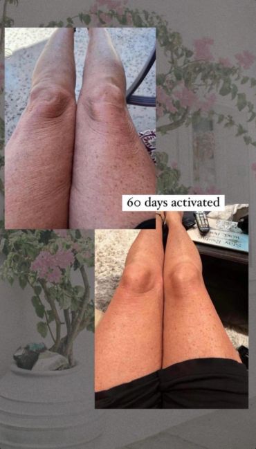 Comparison of legs before and after 60 days of activation treatment.
