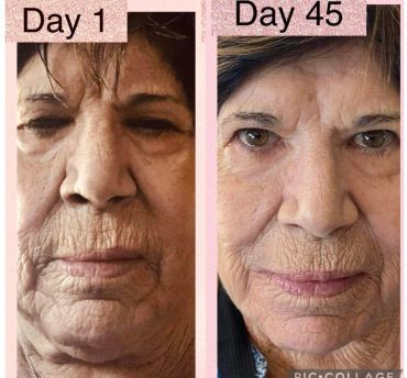 Before and after facial skin treatment, Days 1 and 45.