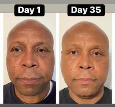 Comparison of a man's face on Day 1 and Day 35.
