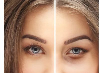 Lumineyes treatment is a non-surgical cosmetic procedure for dark circles and under eye bags