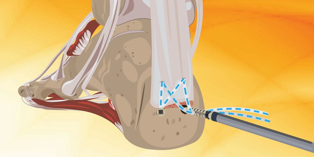 Tigon Medical Achilles Surgical Procedure