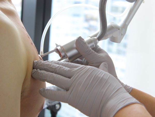 Tattoo removals