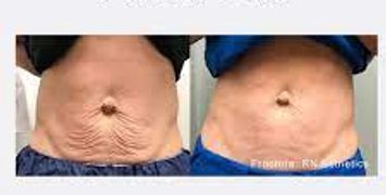 Fractora, skin renewal, body shaping, toning, face, body, non Surgical , cosmetic, wrinkle reduction
