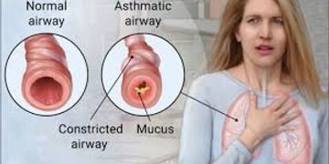 Asthma and Allergic Cough