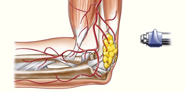 Shockwave therapy elbow pain