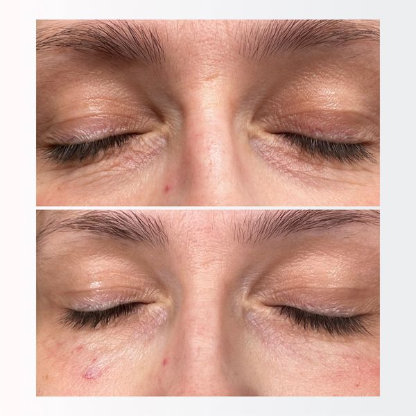 before and after of Lumi eye skin booster treatment