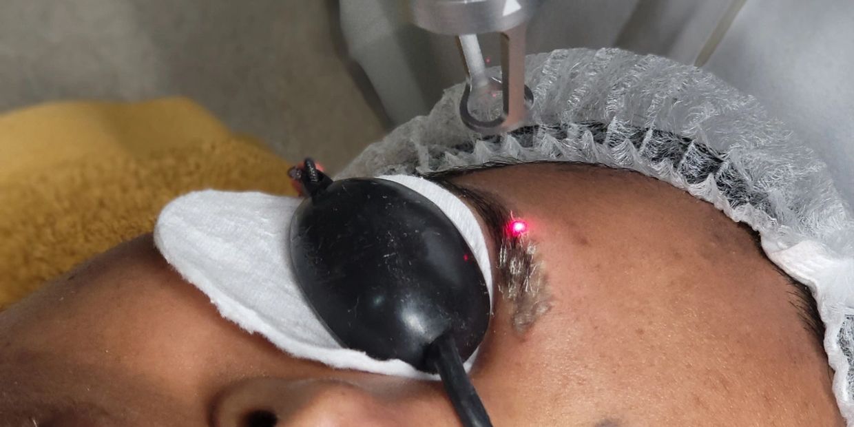 Serviço de Remoção de Tatuagens na Pure Senses, clínica localizada na zona da Boavista, no Porto