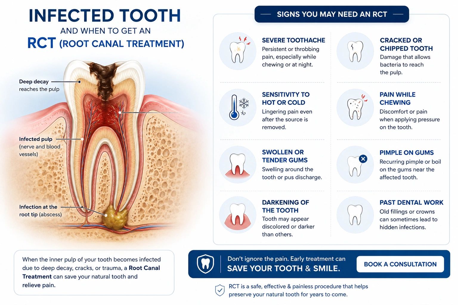 Illustration of infected tooth and signs for root canal treatment (RCT).