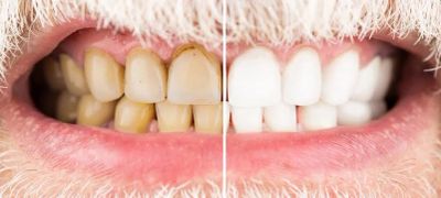 Close-up of teeth showing before and after whitening.
