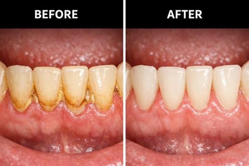 Teeth before and after cleaning showing plaque removal.
