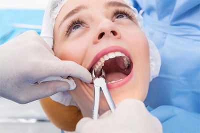 Dentist extracting a tooth from a patient's mouth using dental forceps.