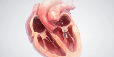 Illustration of PReduction device to treat HFpEF