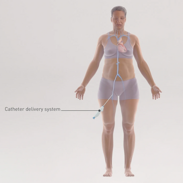 Illustration of femoral venous and transseptal route used by transcatheter delivery system.