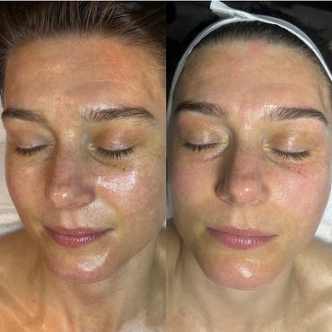 Before and after facial treatment, close up.