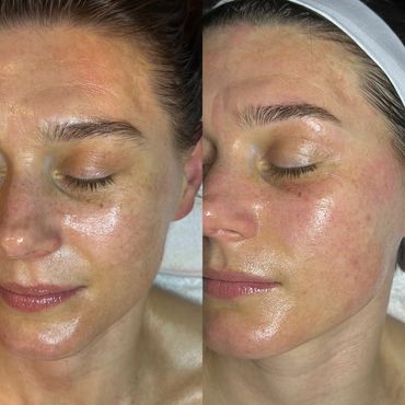 Before and after facial treatment, close up with different lighting.