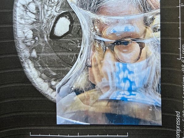 Multimedia collage - self portrait with MRI image of cross section of fibrotic leg. Living with lymp