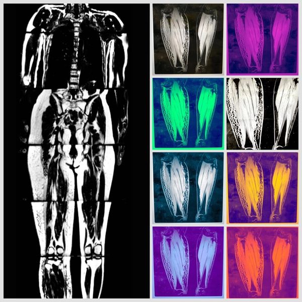 Digital art with the MRI of my lymphedema - from Vanderbilt University research study