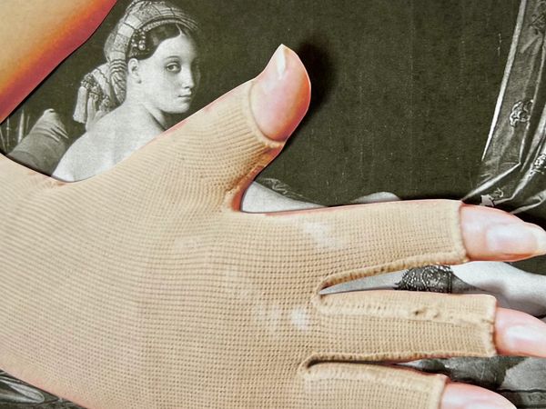 Collage of beauty with lymphedema -compression glove, body image, and the gaze. 
