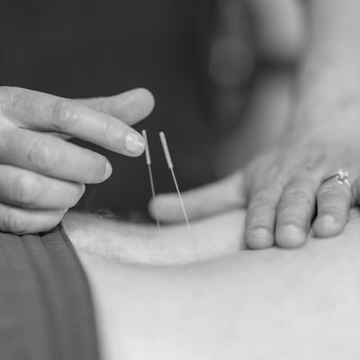 lady administering dry needling into person's back