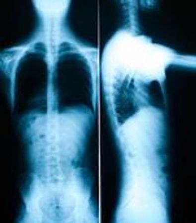 X-ray images showing front and side views of a human torso and spine.