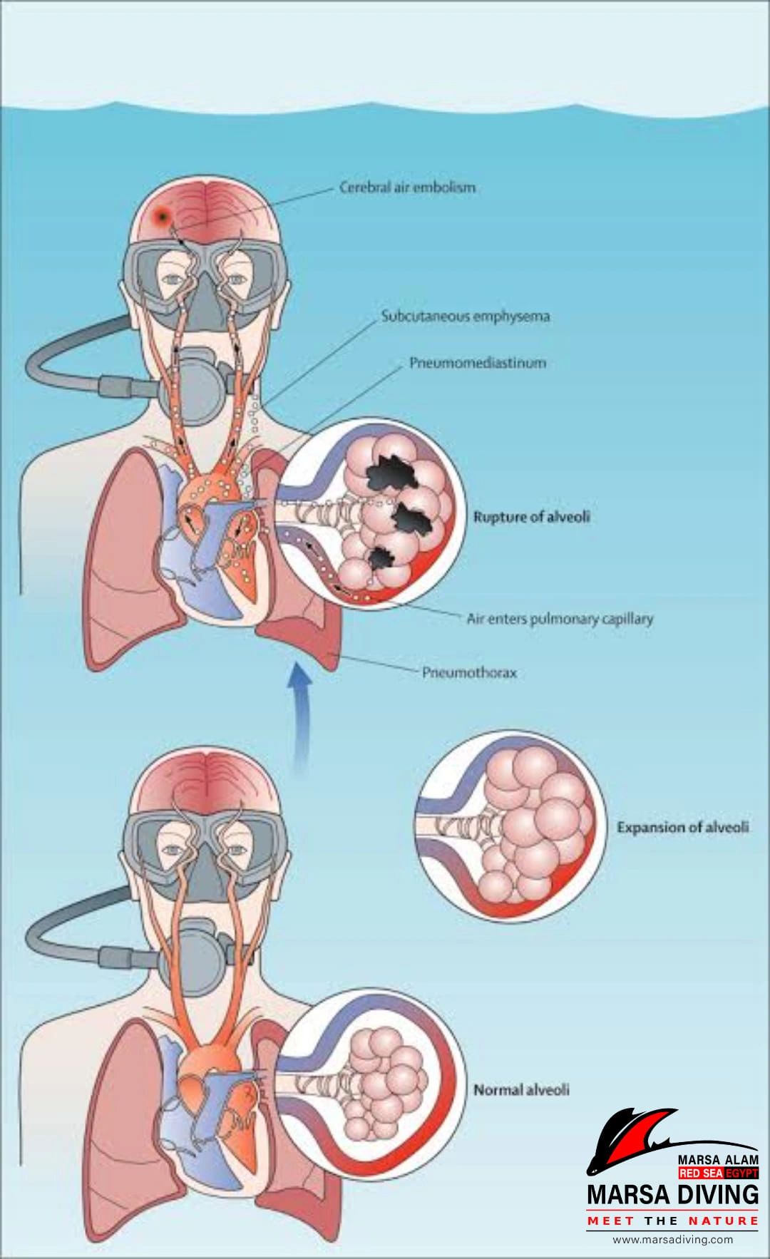 Illness (Diving Disease)! What Is It