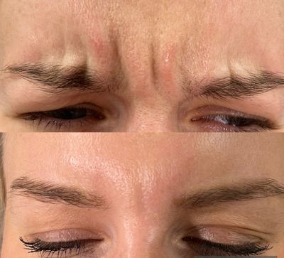 Before & After Anti Wrinkle Treatment