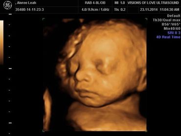 3D/4D ultrasound