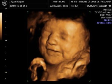 3D/4D ultrasound