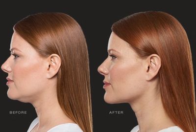 Kybella Transformation Photo. Red hair woman before and after photo. 