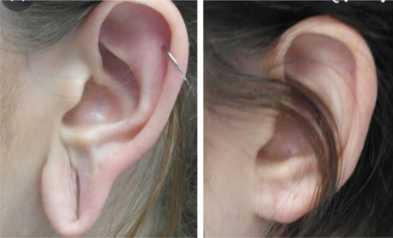Shivam Jewellers - ~~~EAR LOBE REPAIR~~~ !Without stitching