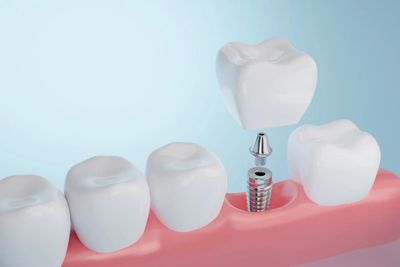 3D illustration of a dental implant being placed in the gum.